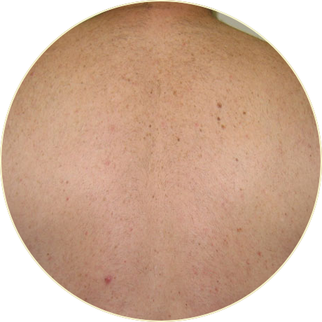 Laser Hair Removal | Bishops Cleeve Cheltenham Laser Hair Removal | Bishops Cleeve Cheltenham
