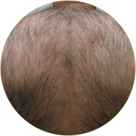 Laser Hair Removal | Bishops Cleeve Cheltenham Laser Hair Removal | Bishops Cleeve Cheltenham