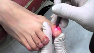 Laser Fungal Nail Treatment | Bishops Cleeve Cheltenham