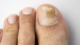 Laser Fungal Nail Treatment | Bishops Cleeve Cheltenham