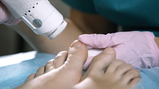 Laser Fungal Nail Treatment | Bishops Cleeve Cheltenham