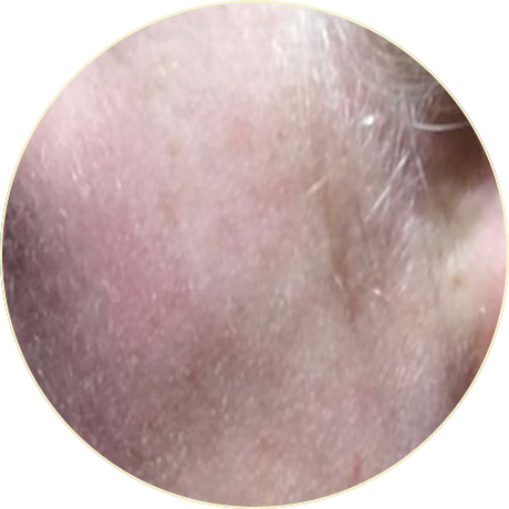 Laser Pigmentation Removal | Bishops Cleeve Cheltenham Laser Pigmentation Removal | Bishops Cleeve Cheltenham