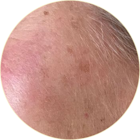 Laser Pigmentation Removal | Bishops Cleeve Cheltenham Laser Pigmentation Removal | Bishops Cleeve Cheltenham