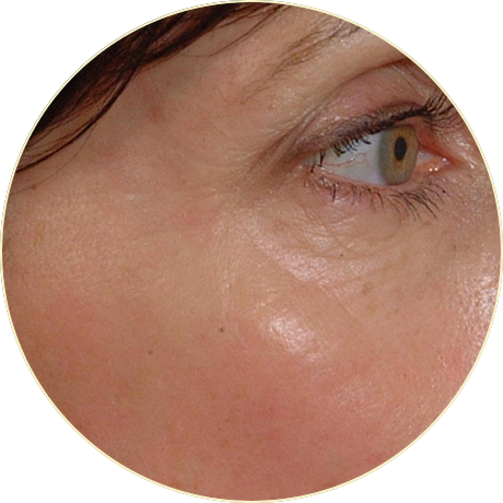 Laser Skin Rejuvenation | Bishops Cleeve Cheltenham Laser Skin Rejuvenation | Bishops Cleeve Cheltenham