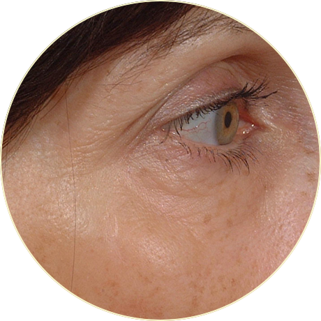 Laser Skin Rejuvenation | Bishops Cleeve Cheltenham Laser Skin Rejuvenation | Bishops Cleeve Cheltenham
