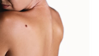 Laser Vascular Treatment | Bishops Cleeve Cheltenham