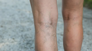 Laser Vascular Treatment | Bishops Cleeve Cheltenham Laser Vascular Treatment | Bishops Cleeve Cheltenham