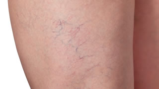 Laser Vascular Treatment | Bishops Cleeve Cheltenham Laser Vascular Treatment | Bishops Cleeve Cheltenham
