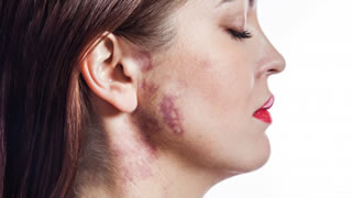 Laser Vascular Treatment | Bishops Cleeve Cheltenham Laser Vascular Treatment | Bishops Cleeve Cheltenham
