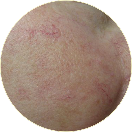 Laser Vascular Treatment | Bishops Cleeve Cheltenham Laser Vascular Treatment | Bishops Cleeve Cheltenham