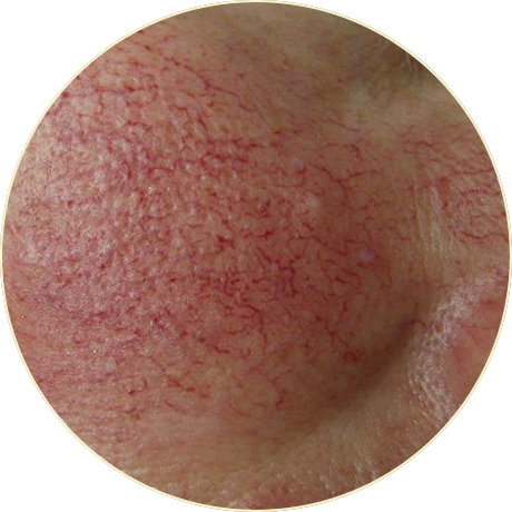 Laser Vascular Treatment | Bishops Cleeve Cheltenham Laser Vascular Treatment | Bishops Cleeve Cheltenham