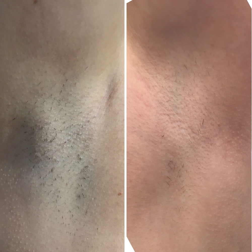 Laser Hair Removal | Skin Perfection Cheltenham