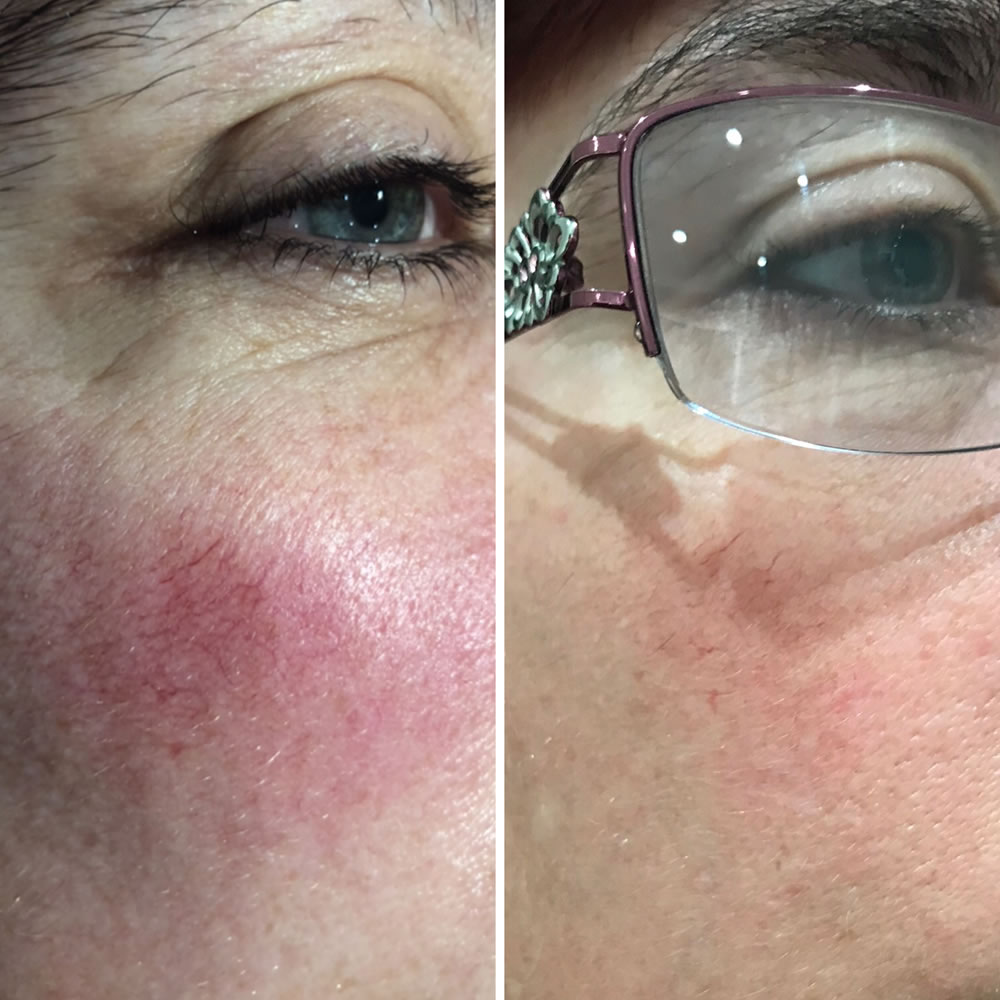 Laser Photo Rejuvenation | Skin Perfection Cheltenham