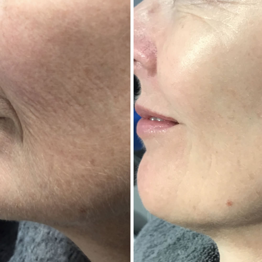 Laser Photo Rejuvenation | Skin Perfection Cheltenham