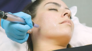 Microneedling | Bishops Cleeve Cheltenham