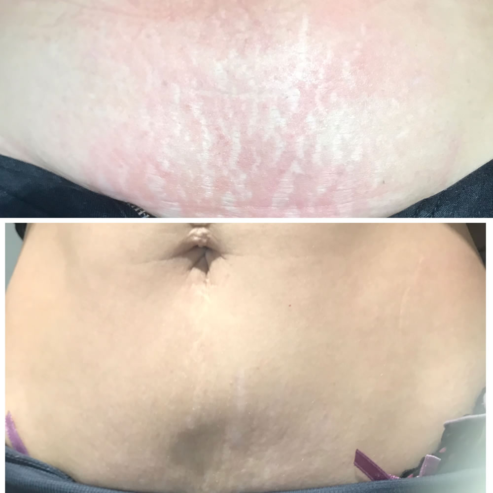 Plasma Skin Tightening | Skin Perfection Cheltenham