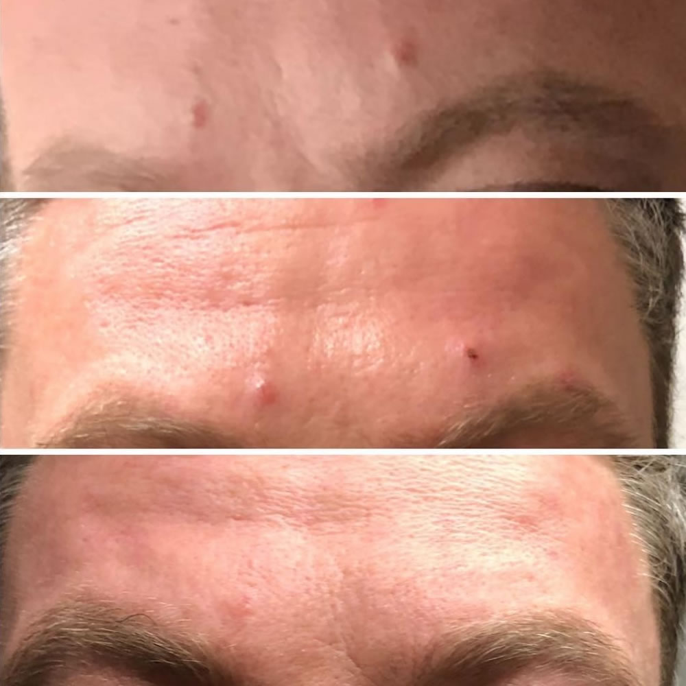 Skin Tag Removal | Skin Perfection Cheltenham