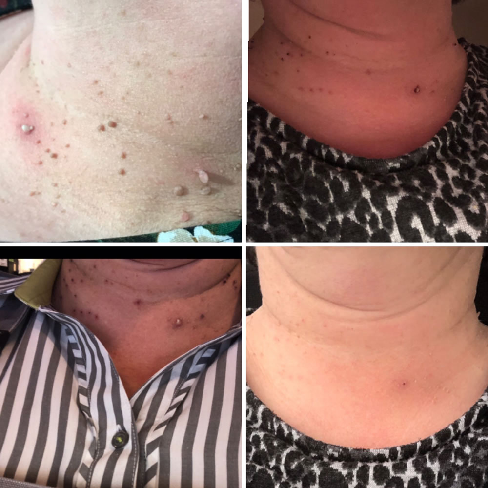 Skin Tag Removal | Skin Perfection Cheltenham