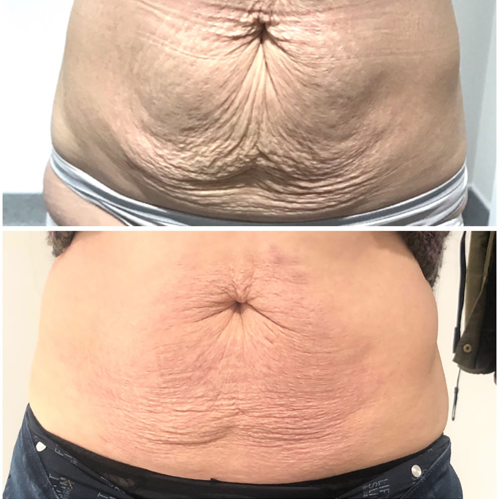 Plasma Tummy Tuck | Skin Perfection Cheltenham