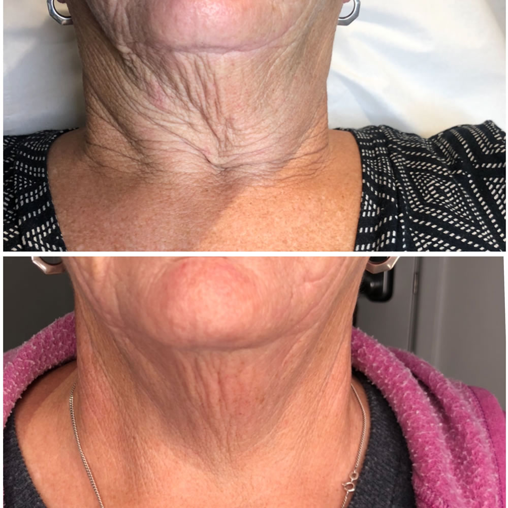 Plasma Skin Tightening | Skin Perfection Cheltenham