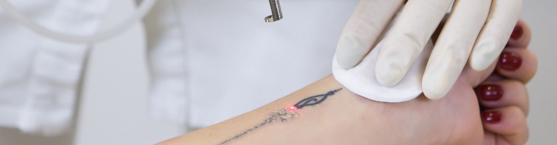 Laser Tattoo Removal Cheltenham | Skin Perfection
