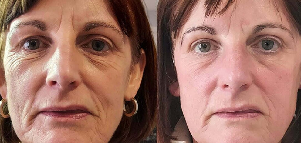 Collagen Lift Cheltenham