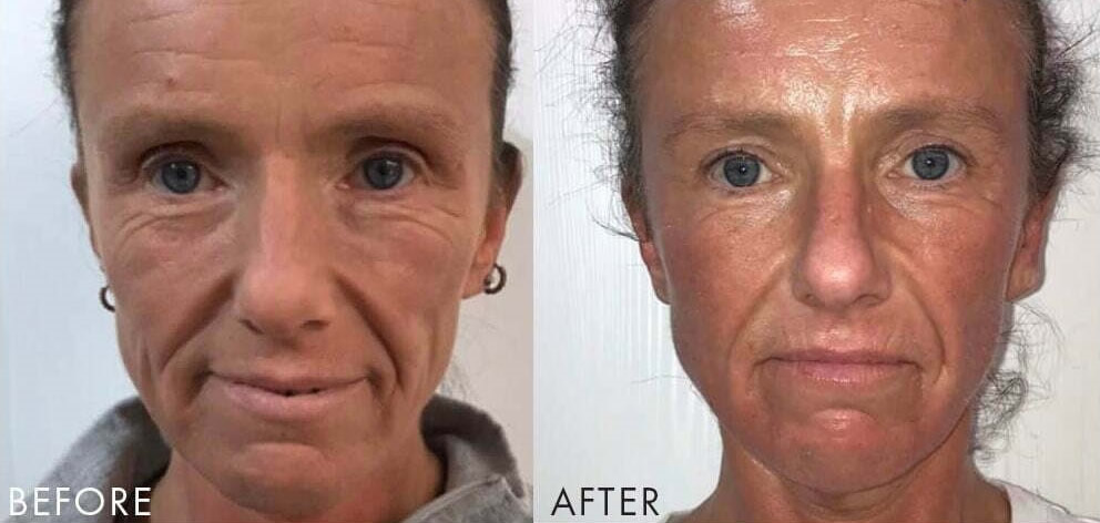 Collagen Lift Cheltenham