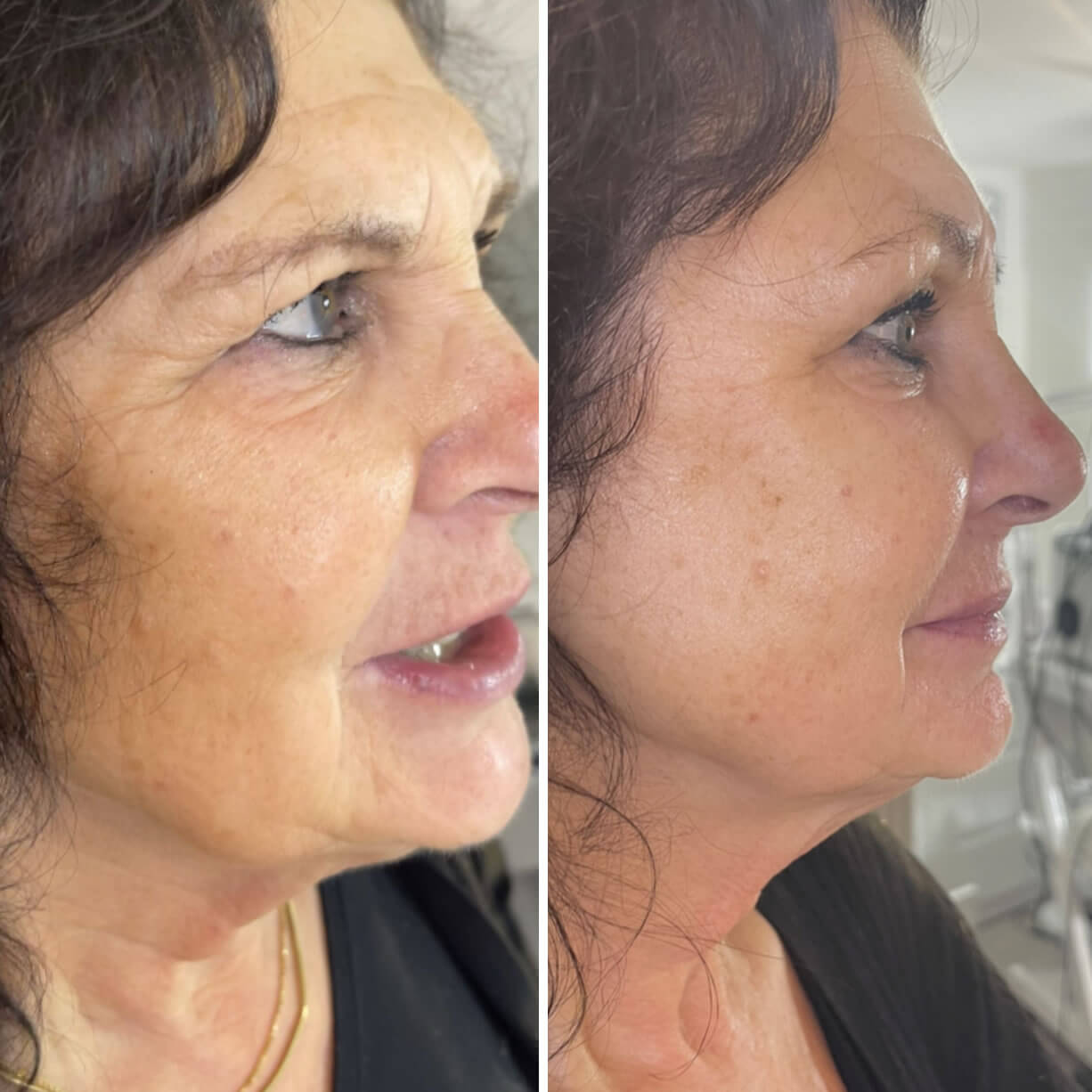 Collagen Lift Cheltenham