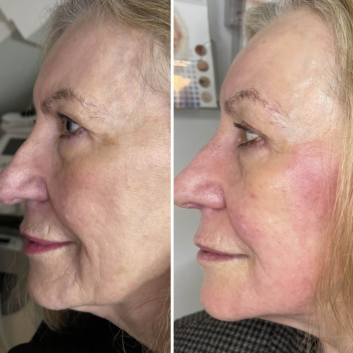 Collagen Lift Cheltenham